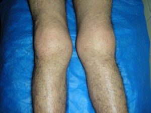 paquidermo-periostefbfbdsis-defbfbdvila-eduardo-hc-6307-03