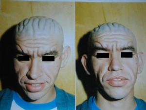 paquidermoperiostosis-11