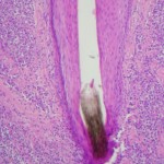 foliculitis-10-x