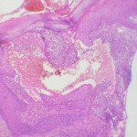 foliculitis-4-x