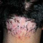 foliculitis-hipertrofica-de-la-nuca-martinez-carlos-hc-6447-03