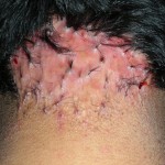 foliculitis-hipertrofica-de-la-nuca-martinez-carlos-hc-6447-09