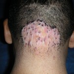 foliculitis-hipertrofica-de-la-nuca-martinez-carlos-hc-6447-14