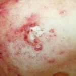 acne1