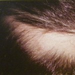 alopecia