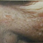 elastoidosis