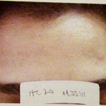 melasma
