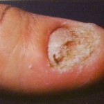 psoriacico psoriacico